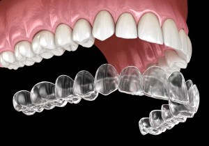 clear aligners