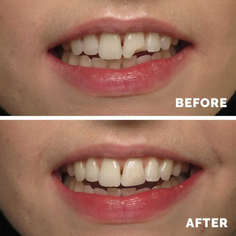composite bonding single tooth
