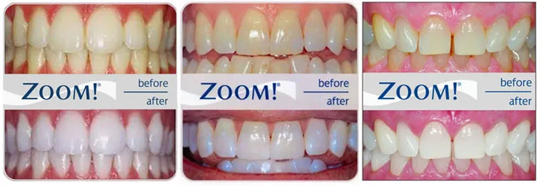 zoom teeth whitening before and after