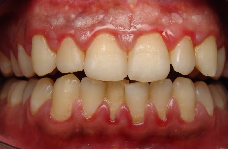 gum disease 2