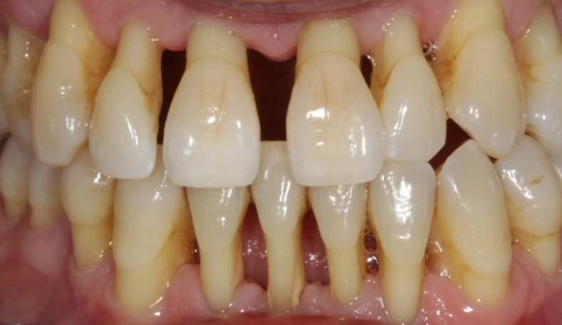 gum disease 3