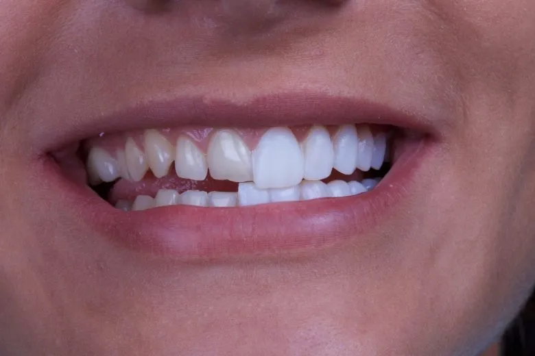 Smile with the right side having veneers and the left side not